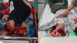 Kontainer Lepas di Takalar, Dua Mahasiswi Jalani Amputasi Kaki Kanan